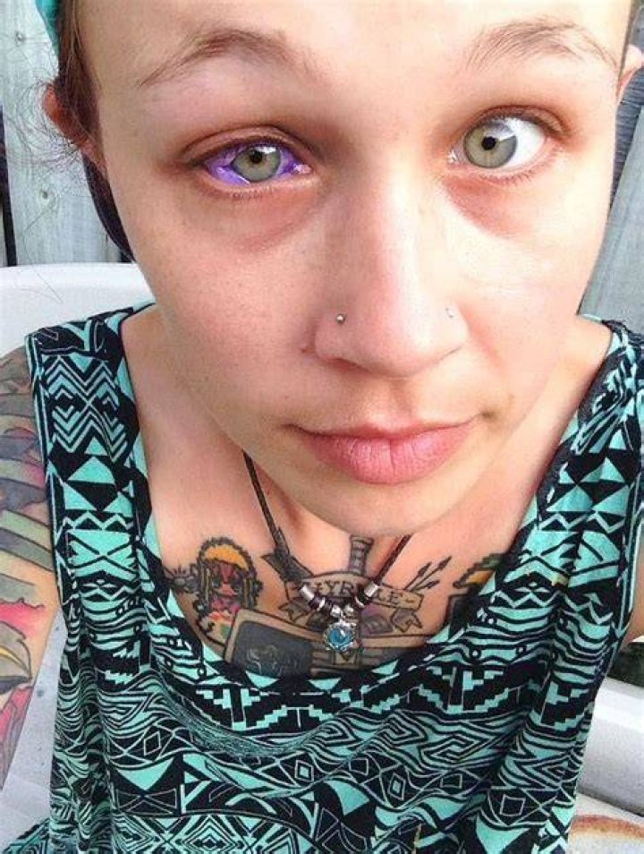 Canadian model Catt Gallinger left partially blind due to eyeball tattooing! Know what the inventor Luna Cobra and AAO has to say about this body modification technique!