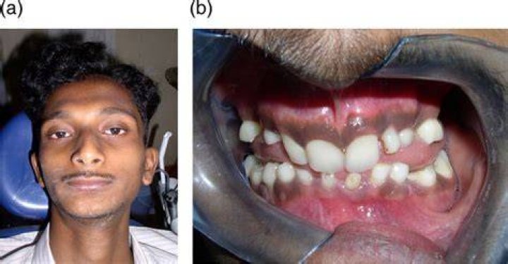 CoryxKenshin Teeth
