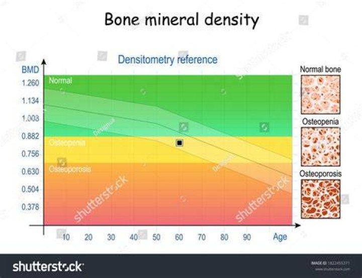 FREE BONE MINERAL DENSITY (BMD) CAMP Organized by the Department of PG