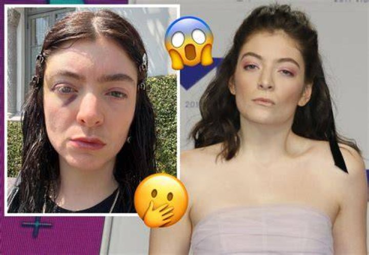 Know the latest on Lorde’s ‘autoimmune’ controversy! Social media backlashes, apologies and more! Source: Perez Hilton (Lorde-James split)