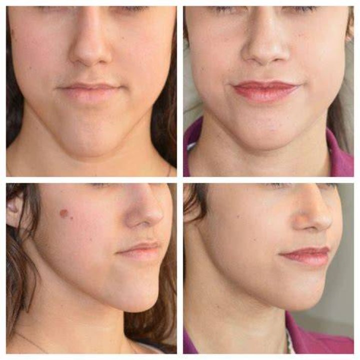 The Ugly Truth: Double Jaw Surgery Gone Horribly Wrong