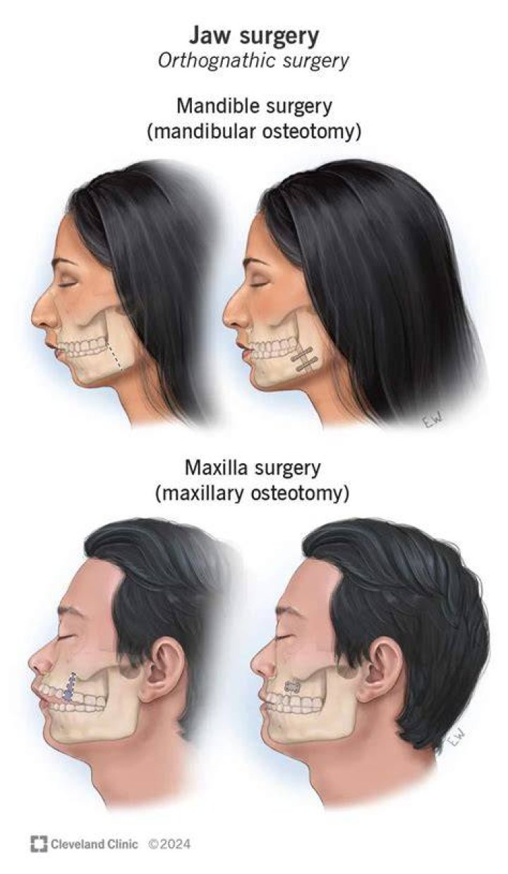 Underbite Surgery Swelling
